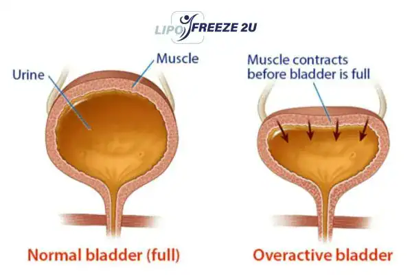 diagram of overactive bladder treatment Greater Manchester