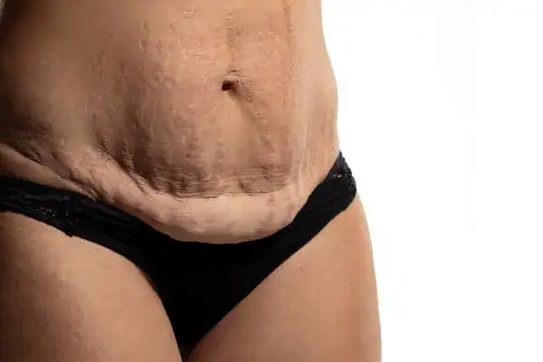 loose skin after weight loss injections Greater Manchester