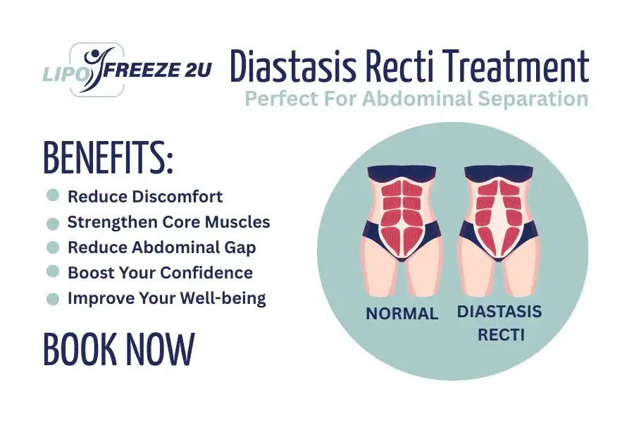 How Long Will It Take to See Improvements in Diastasis Recti Greater Manchester