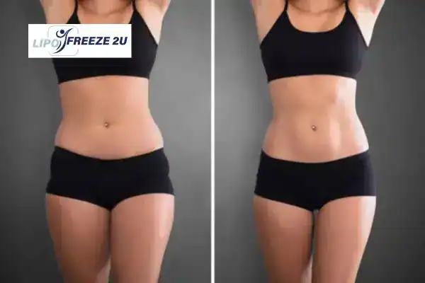 How Can LIPO FREEZE 2U Support Your Post-Pregnancy Body Recovery Greater Manchester?