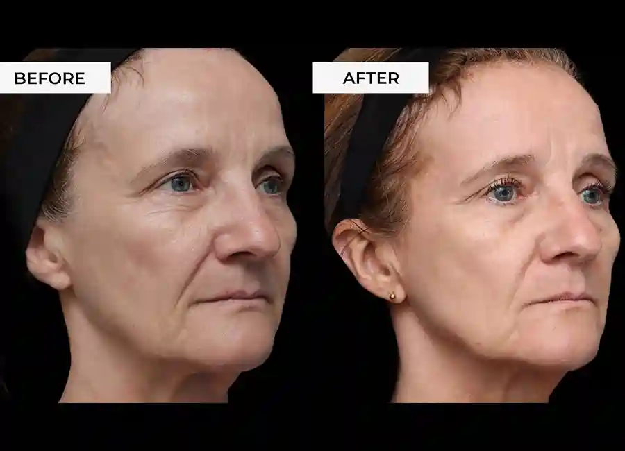How Many RF Microneedling Sessions Will You Need to See a Difference Greater Manchester?